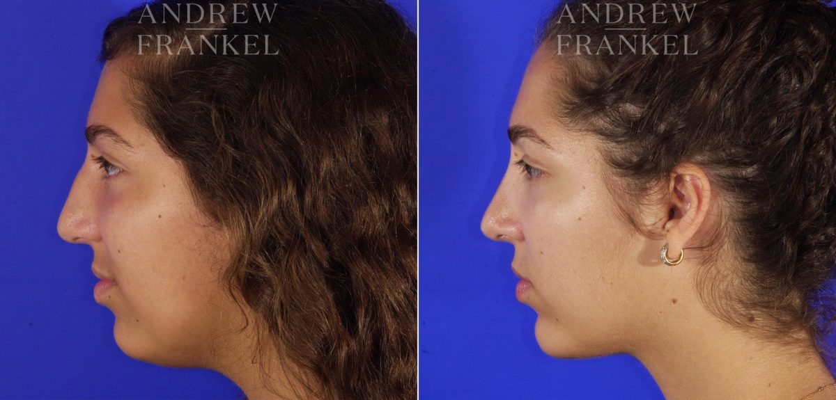 Jawline Contouring before and after photos in Beverly Hills, CA, Patient 14563