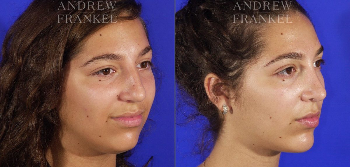 Jawline Contouring before and after photos in Beverly Hills, CA, Patient 14563