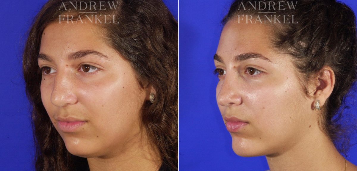 Jawline Contouring before and after photos in Beverly Hills, CA, Patient 14563