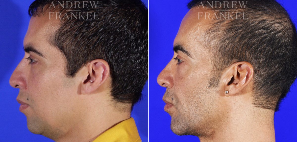 Jawline Contouring before and after photos in Beverly Hills, CA, Patient 14529