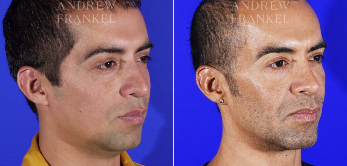 Jawline Contouring before and after photos in Beverly Hills, CA, Patient 14529