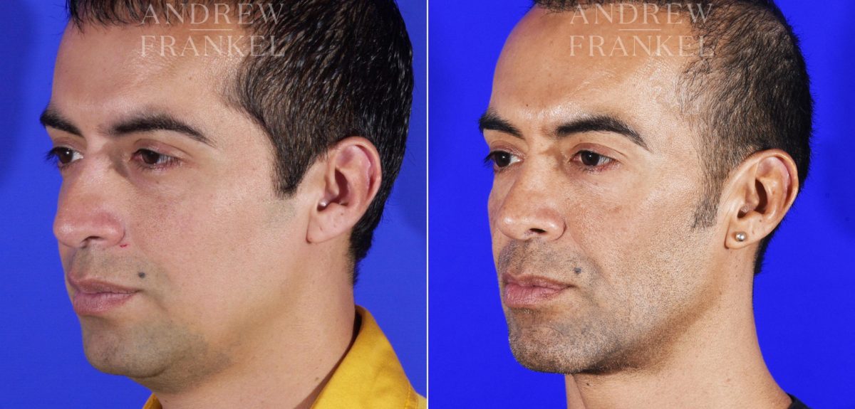 Jawline Contouring before and after photos in Beverly Hills, CA, Patient 14529