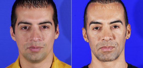 Jawline Contouring before and after photos in Beverly Hills, CA, Patient 14529