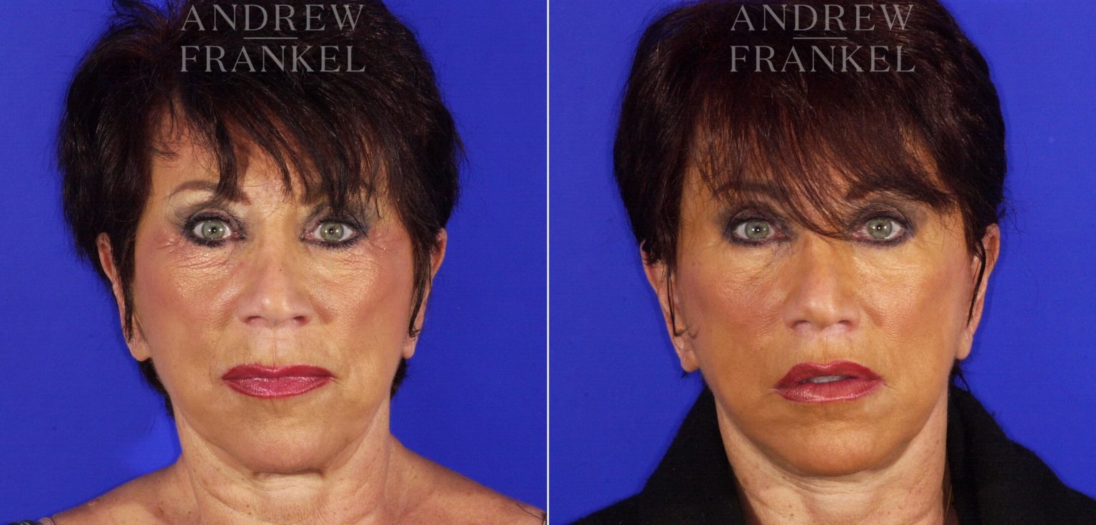 Lip Lift photos Beverly Hills, CA. Patient 4431