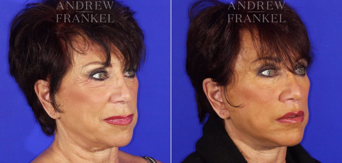 Lip Lift before and after photos in Beverly Hills, CA, Patient 11360
