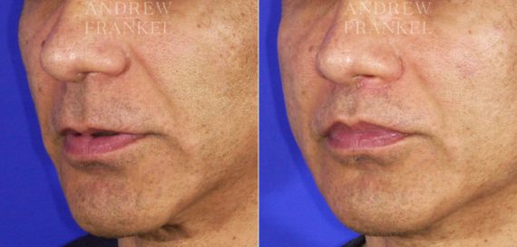 Lip Lift before and after photos in Beverly Hills, CA, Patient 11370