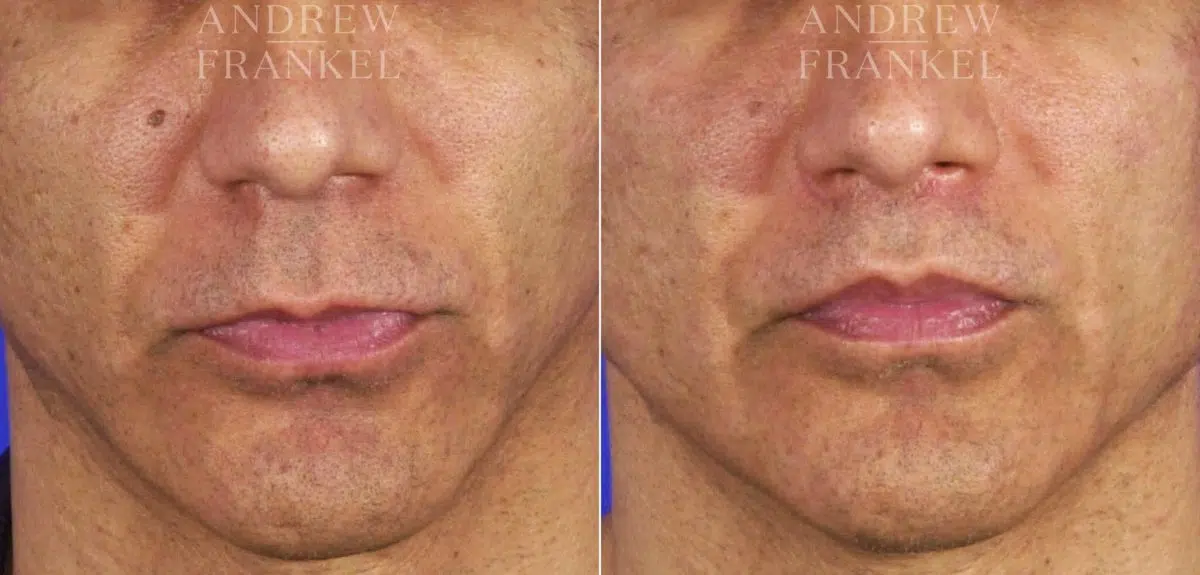Lip Lift before and after photos in Beverly Hills, CA, Patient 11370