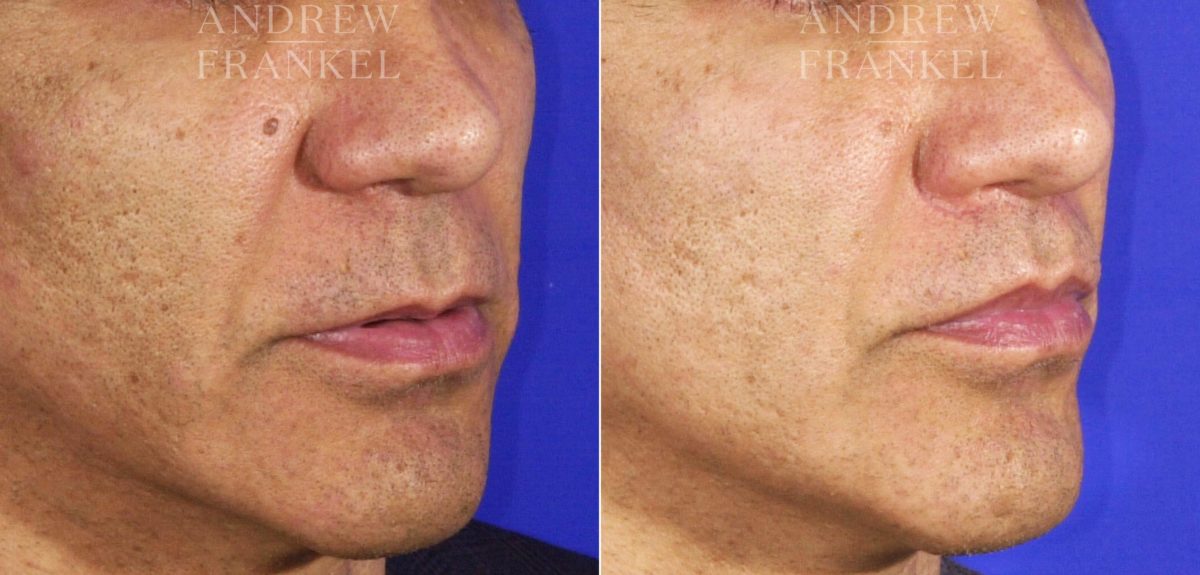 Lip Lift before and after photos in Beverly Hills, CA, Patient 11370