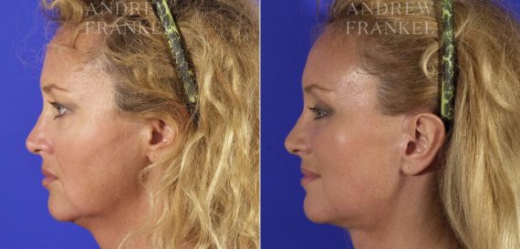 Facial Rejuvenation before and after photos in Beverly Hills, CA, Patient 11396