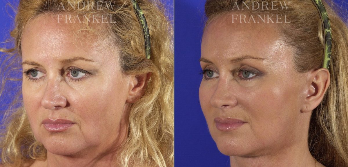 Facial Rejuvenation before and after photos in Beverly Hills, CA, Patient 11396