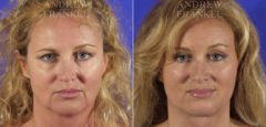 Facial Rejuvenation before and after photos in Beverly Hills, CA, Patient 11396