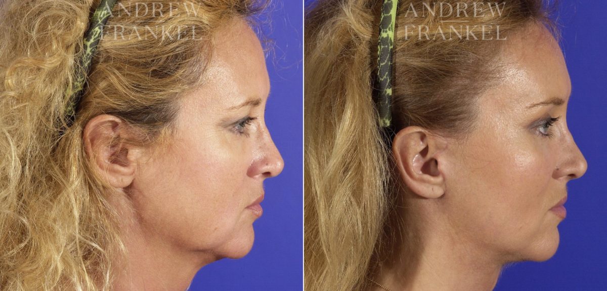 Facial Rejuvenation before and after photos in Beverly Hills, CA, Patient 11396