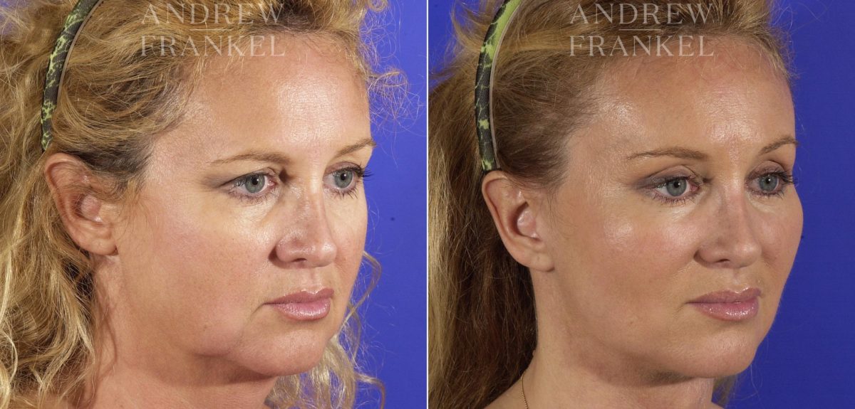 Facial Rejuvenation before and after photos in Beverly Hills, CA, Patient 11396