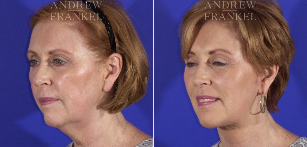 Facelift before and after photos in Beverly Hills, CA, Patient 11460