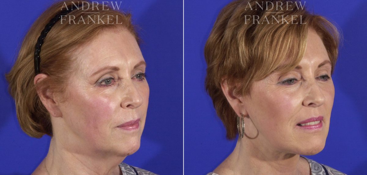 Facelift before and after photos in Beverly Hills, CA, Patient 11460