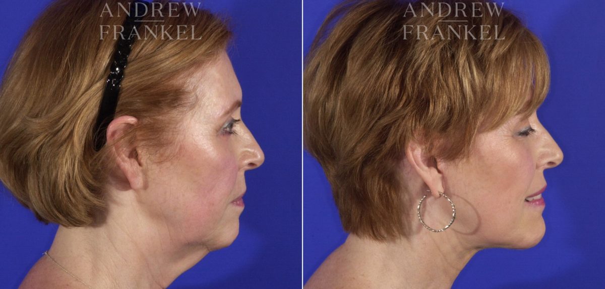 Facelift before and after photos in Beverly Hills, CA, Patient 11460