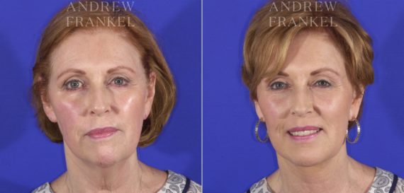 Facelift before and after photos in Beverly Hills, CA, Patient 11460