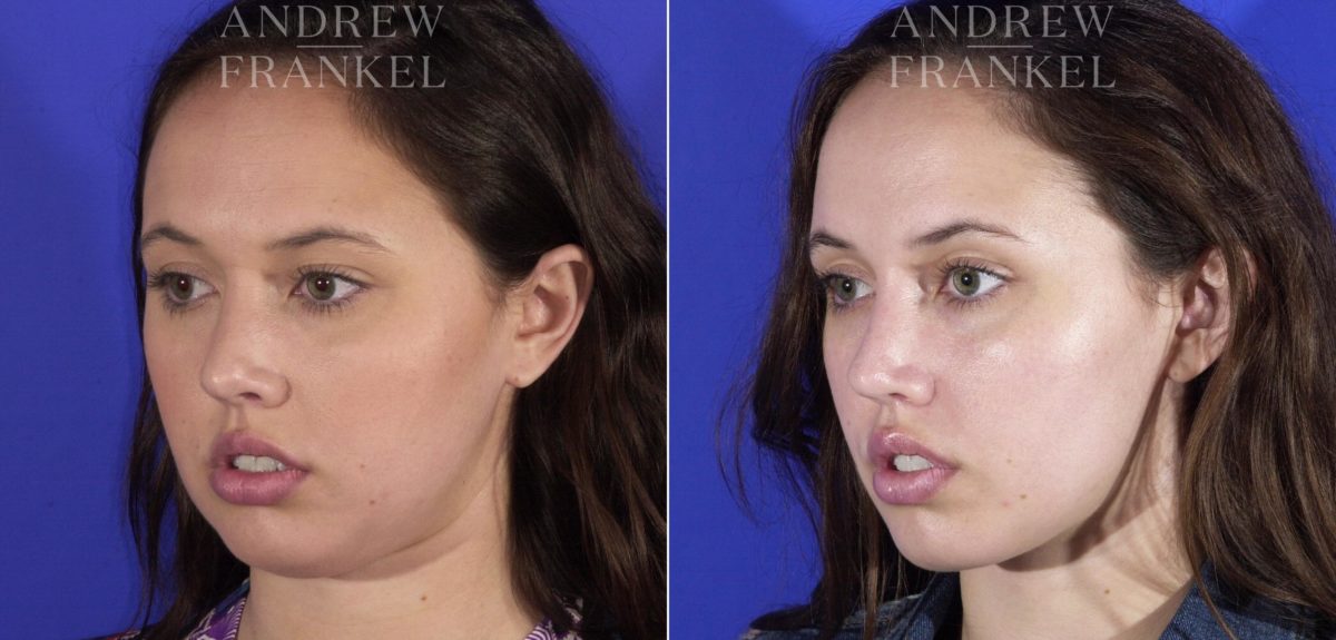 Buccal Fat Removal before and after photos in Beverly Hills, CA, Patient 11514