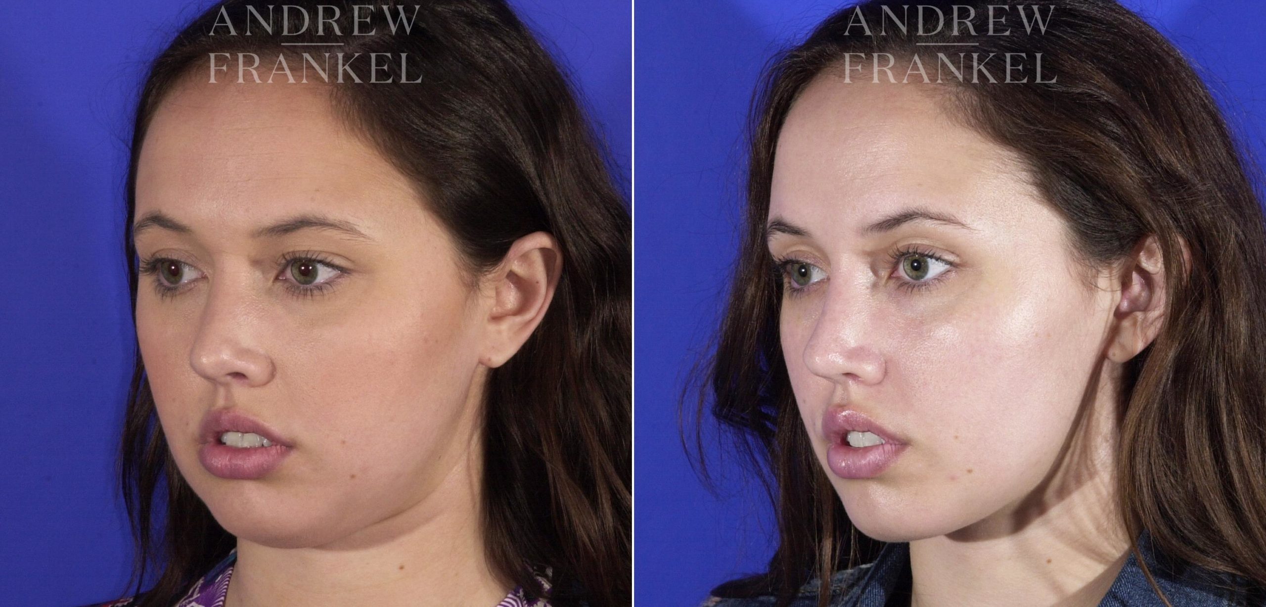 Buccal Fat Removal: What It Is, Recovery & Before & After