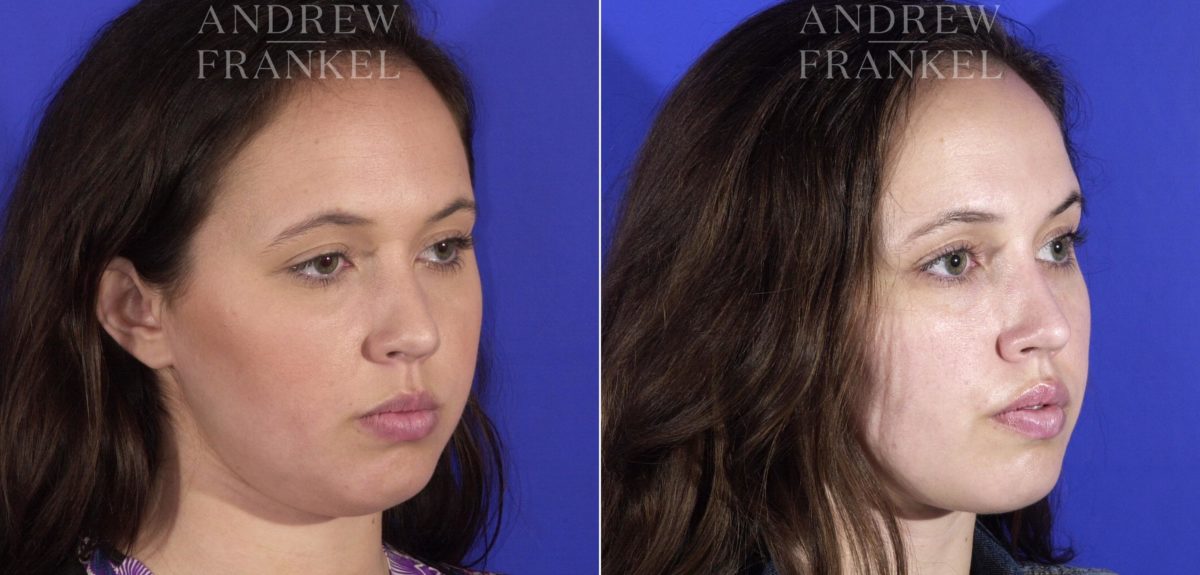 Buccal Fat Removal before and after photos in Beverly Hills, CA, Patient 11514