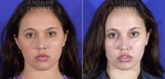 Buccal Fat Removal before and after photos in Beverly Hills, CA, Patient 11514