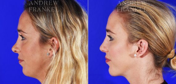 Jawline Contouring before and after photos in Beverly Hills, CA, Patient 12574