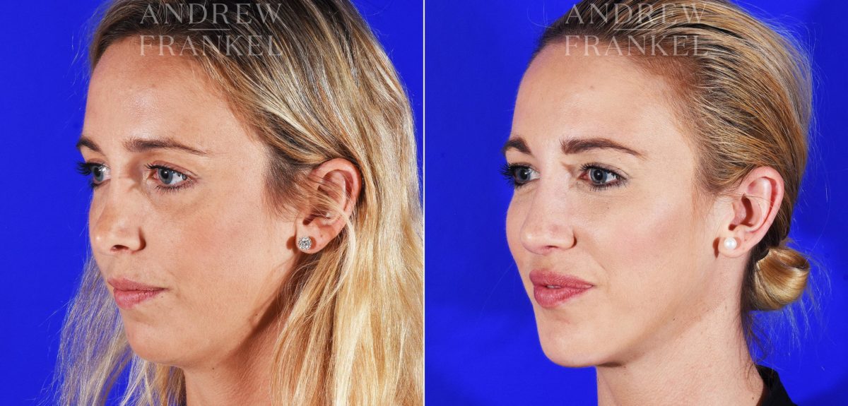 Jawline Contouring before and after photos in Beverly Hills, CA, Patient 12574