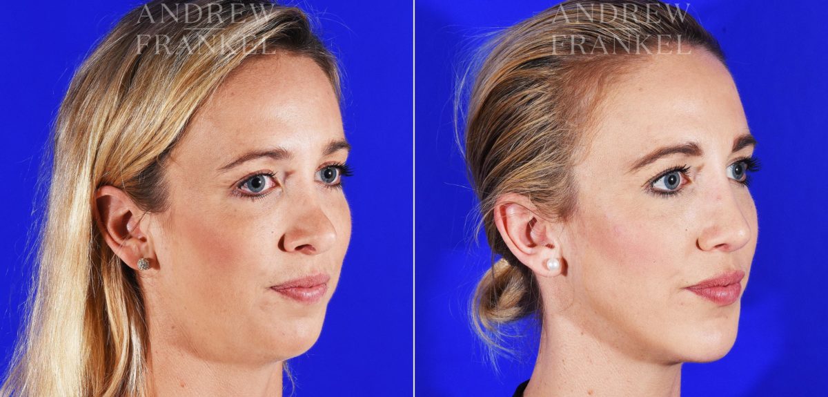 Jawline Contouring before and after photos in Beverly Hills, CA, Patient 12574
