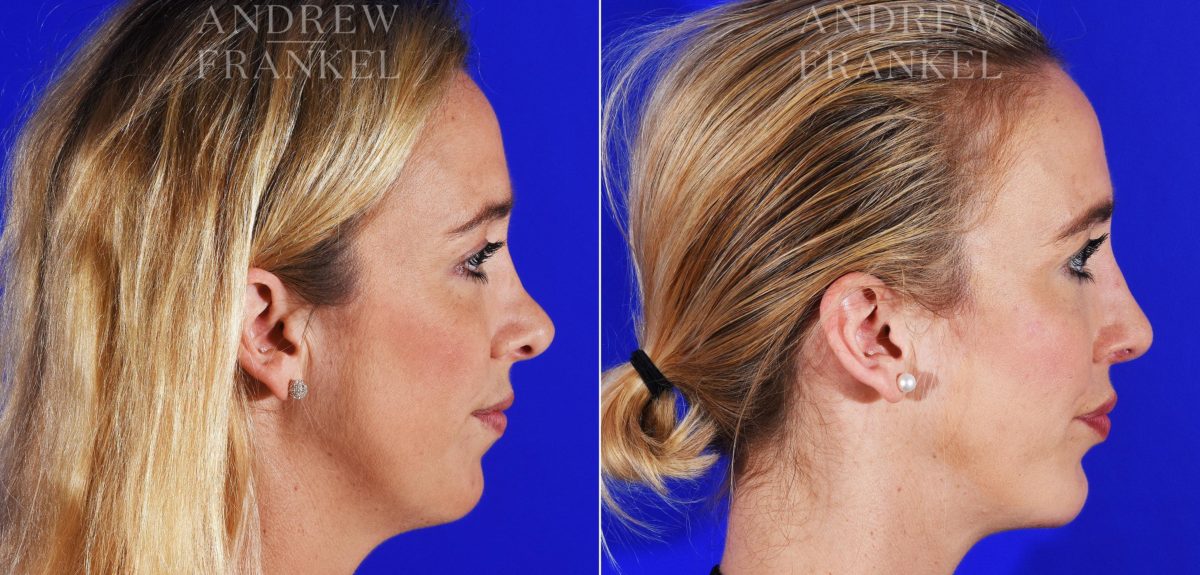 Jawline Contouring before and after photos in Beverly Hills, CA, Patient 12574