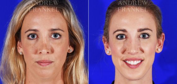 Jawline Contouring before and after photos in Beverly Hills, CA, Patient 12574