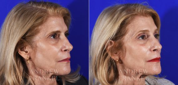 Brow Lift before and after photos in Beverly Hills, CA, Patient 14170