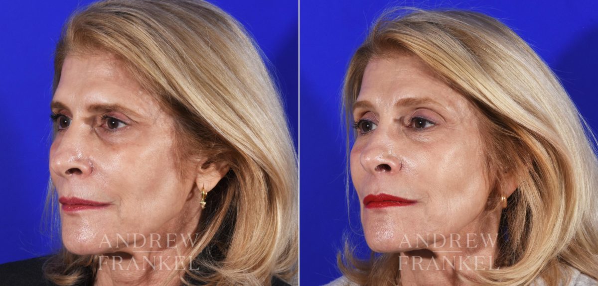 Brow Lift before and after photos in Beverly Hills, CA, Patient 14170