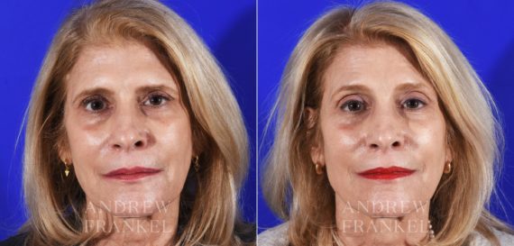 Brow Lift before and after photos in Beverly Hills, CA, Patient 14170