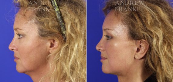 Midface Lift before and after photos in Beverly Hills, CA, Patient 14234