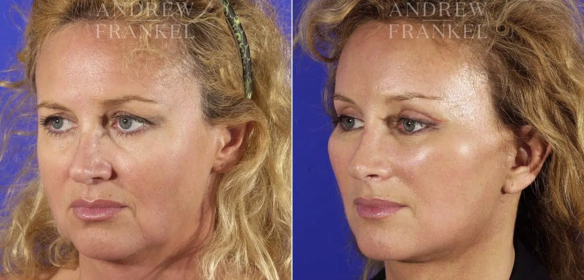 Midface Lift before and after photos in Beverly Hills, CA, Patient 14234