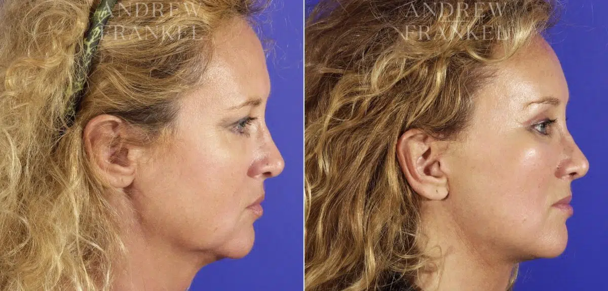 Midface Lift before and after photos in Beverly Hills, CA, Patient 14234