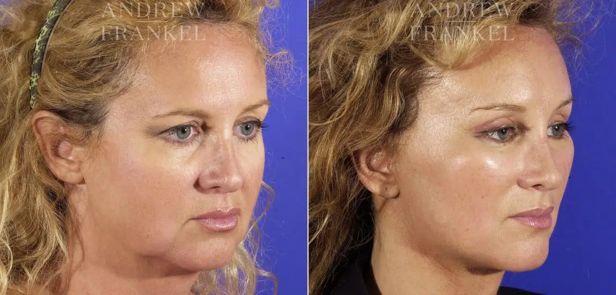 Midface Lift before and after photos in Beverly Hills, CA, Patient 14234