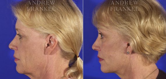 Facelift before and after photos in Beverly Hills, CA, Patient 5439