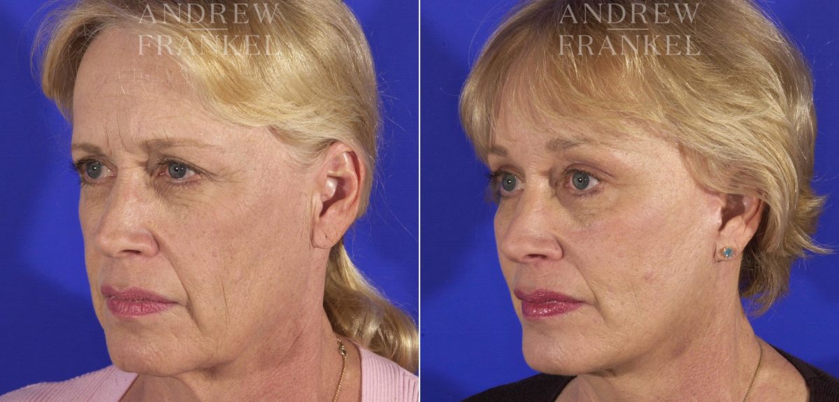 Facelift before and after photos in Beverly Hills, CA, Patient 5439