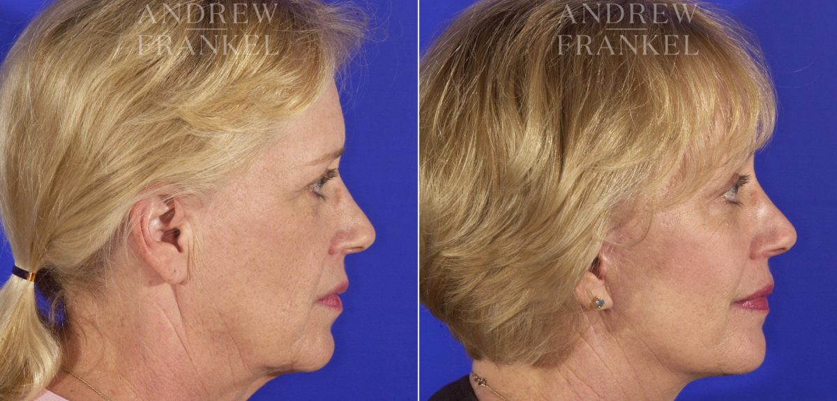 Facelift before and after photos in Beverly Hills, CA, Patient 5439