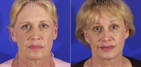 Facelift before and after photos in Beverly Hills, CA, Patient 5439