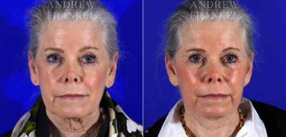 Facelift before and after photos in Beverly Hills, CA, Patient 14983