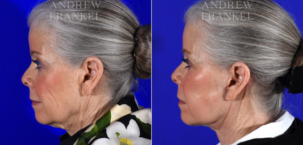 Facelift before and after photos in Beverly Hills, CA, Patient 14983