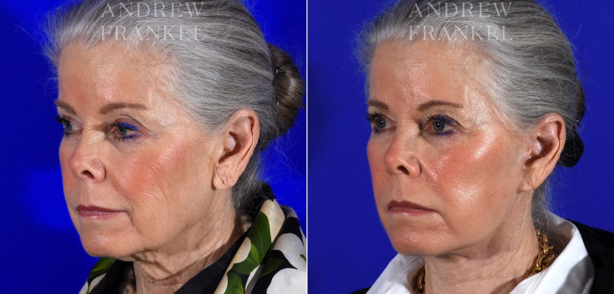 Facelift before and after photos in Beverly Hills, CA, Patient 14983