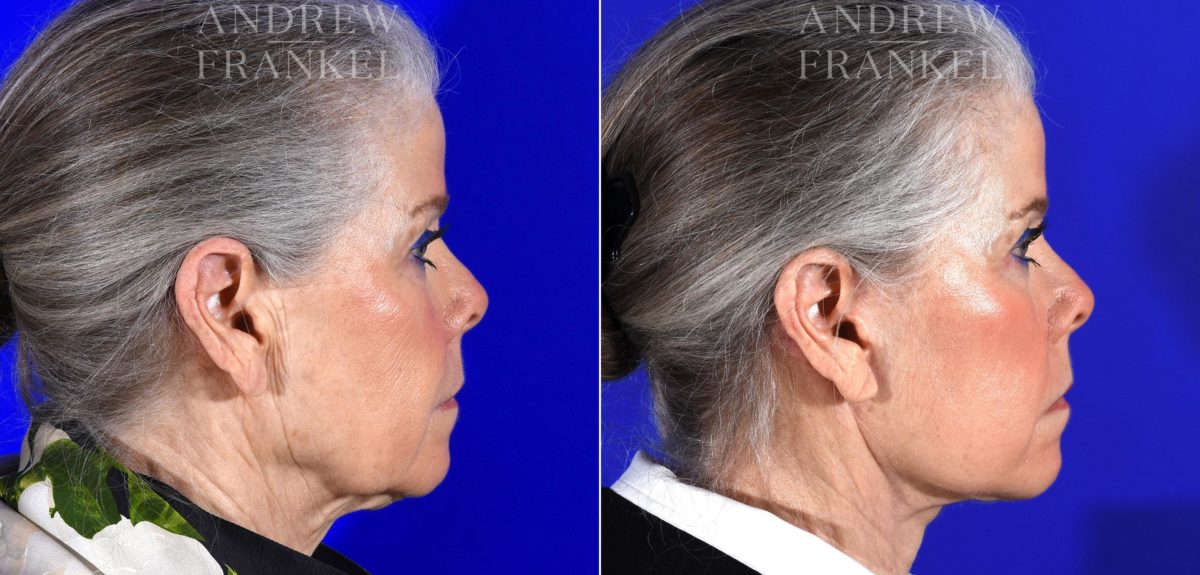 Facelift before and after photos in Beverly Hills, CA, Patient 14983