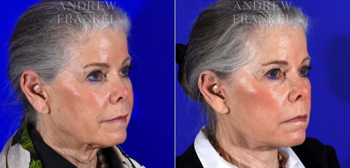 Facelift before and after photos in Beverly Hills, CA, Patient 14983