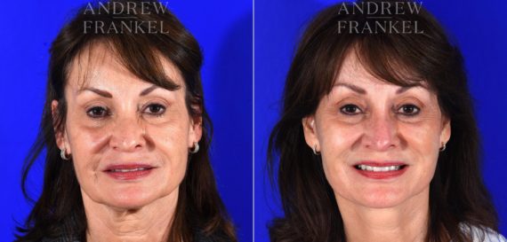 Facelift before and after photos in Beverly Hills, CA, Patient 14988