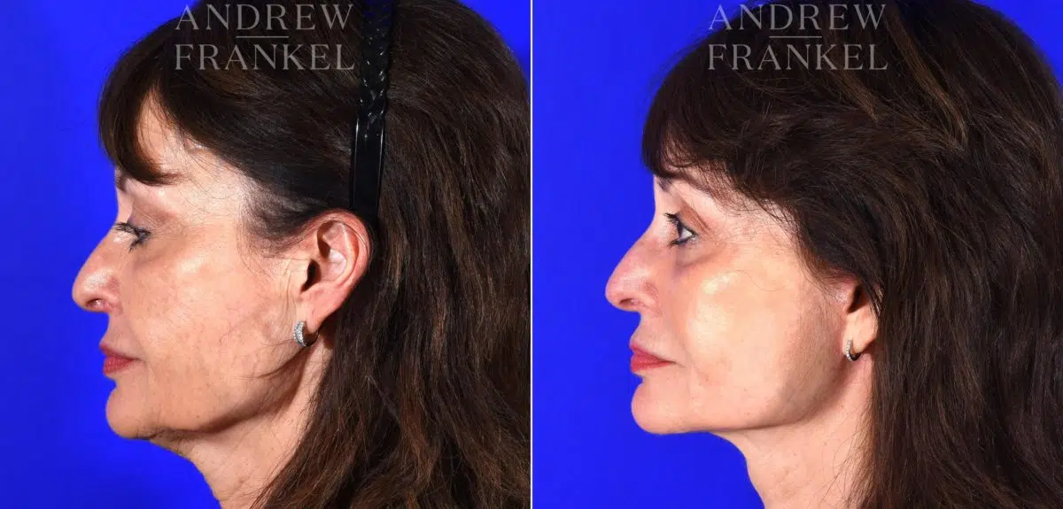 Facelift before and after photos in Beverly Hills, CA, Patient 14988