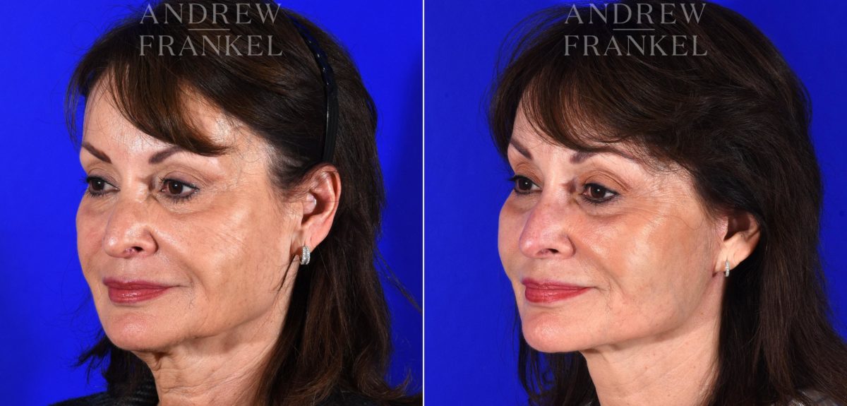 Facelift before and after photos in Beverly Hills, CA, Patient 14988