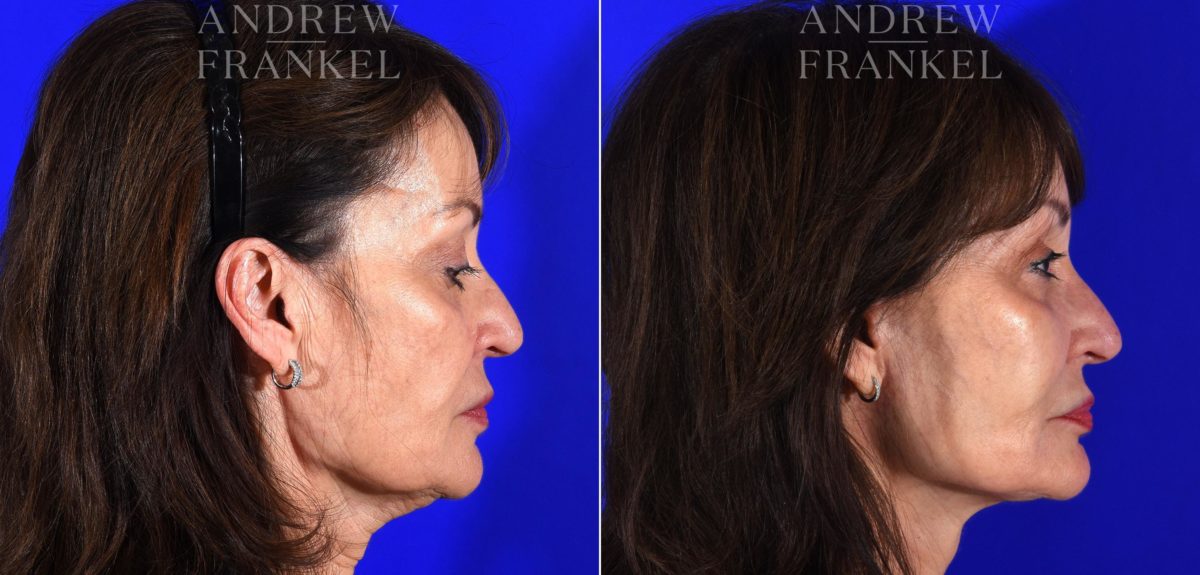 Facelift before and after photos in Beverly Hills, CA, Patient 14988